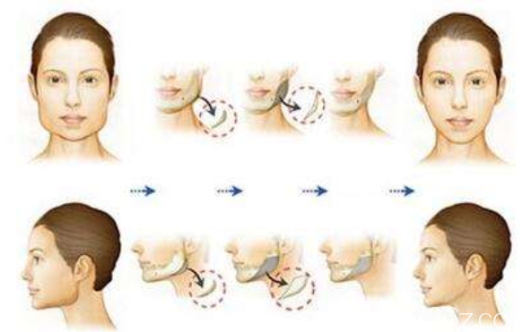 下颌角磨骨术前术后模拟效果对比图
