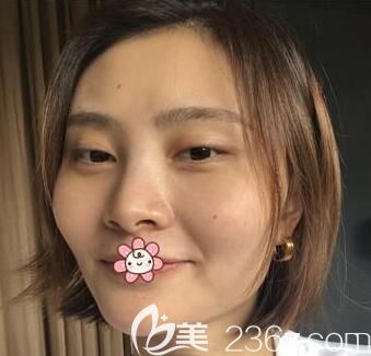 术前我颧骨高,下颌角宽 术前我颧骨高,下颌角宽