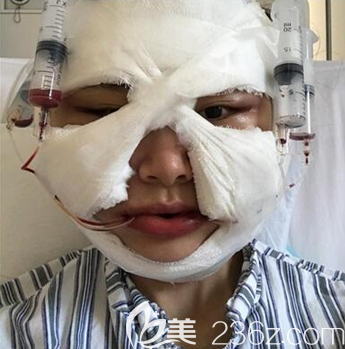 陈小平给我手术后3天