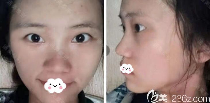 武汉涵美冯晓玲双眼皮<span style= 武汉涵美冯晓玲双眼皮<span style=