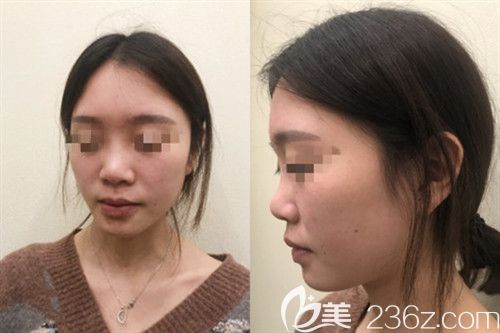 信阳东方艺整形鼻综合真人案例 信阳东方艺整形鼻综合真人案例