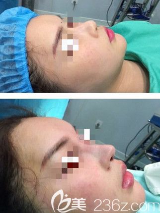 信阳东方人鼻综合术后效果 信阳东方人鼻综合术后效果