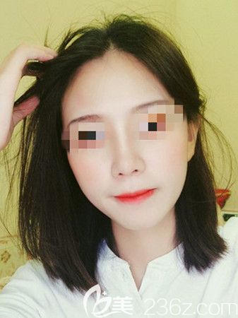 信阳东方艺鼻综合术后15天 信阳东方艺鼻综合术后15天