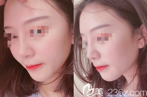 在信阳东方艺做鼻综合手术四个月再也不用担心被人说鼻子很假