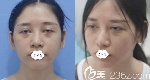 孝感天妃柳肖高难度眼修复案例 孝感天妃柳肖高难度眼修复案例