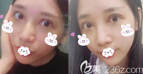 双眼皮过宽修复术后5-7天恢复图 双眼皮过宽修复术后5-7天恢复图