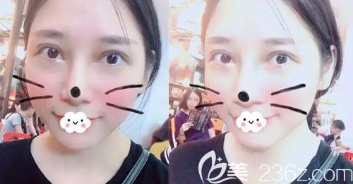 孝感天妃双眼皮失败修复怎么样?真人案例供参考 孝感天妃双眼皮失败修复怎么样?真人案例供参考