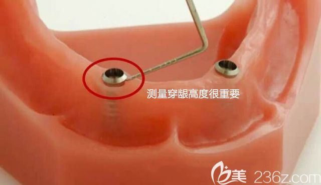 测量穿龈高度图示 测量穿龈高度图示