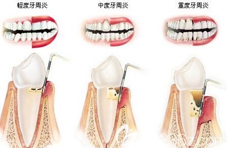 三亚口腔医院符林医生介绍牙周病的治疗方法