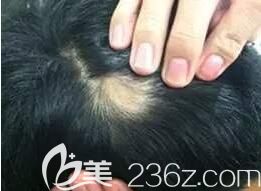 早上掉头发的地方 早上掉头发的地方