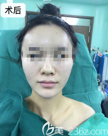 这有一波我刚做完全脸脂肪填充手术当天凹陷的脸颊变圆润的对比照片