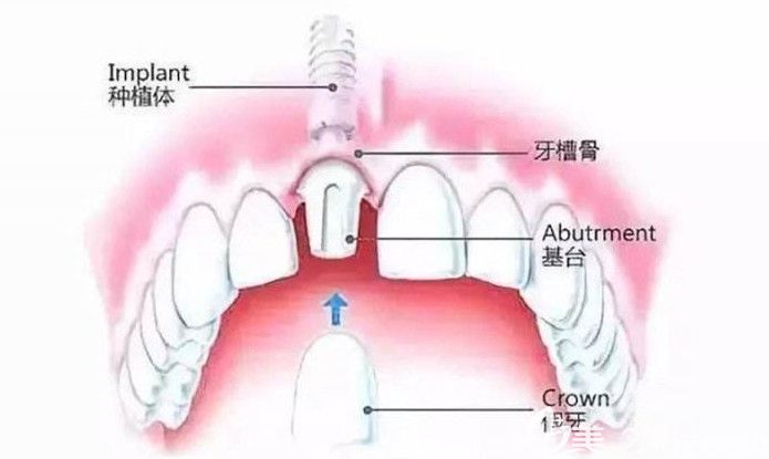 牙齿种植修复过程 牙齿种植修复过程
