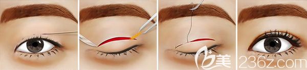 切开双眼皮手术原理 切开双眼皮手术原理