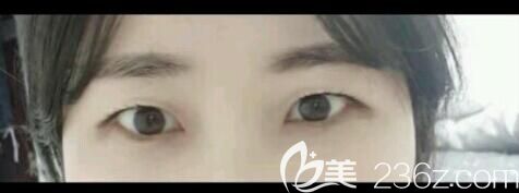 面诊医生术前单眼皮状态 面诊医生术前单眼皮状态