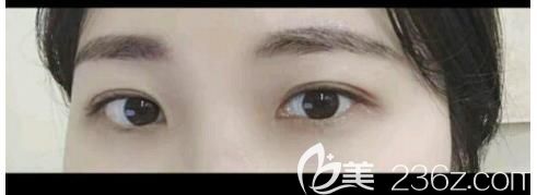 闺蜜做的埋线双眼皮不到一年线就开了，为避免失败我直接做了切开双眼皮