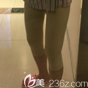 做大腿吸脂术后2天腿部明显肿胀 做大腿吸脂术后2天腿部明显肿胀