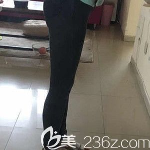 大腿吸脂术后35天身材整体变匀称 大腿吸脂术后35天身材整体变匀称