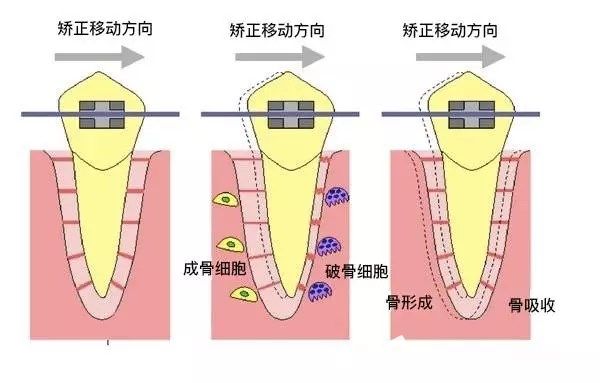 牙齿矫正中移动方向