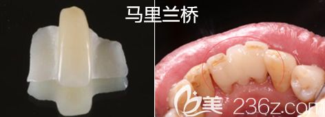 马里兰桥图解