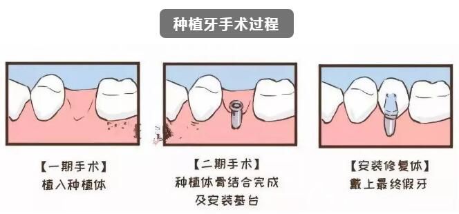 种植牙术后注意事项 种植牙术后注意事项