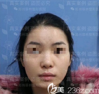 假体隆鼻手术前 假体隆鼻手术前