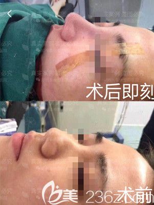 及爱听隆鼻手术术后即刻 及爱听隆鼻手术术后即刻