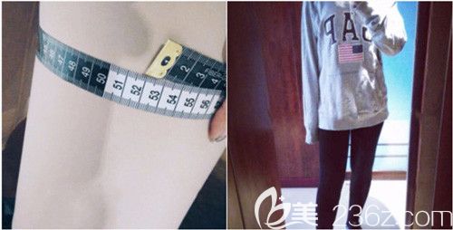 吸脂瘦大腿23天后明显变化