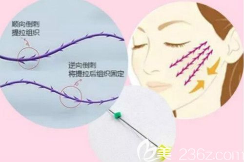 不开刀pst面部提升手术原理 不开刀pst面部提升手术原理