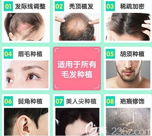 韩妃植发适用于所有毛发种植 韩妃植发适用于所有毛发种植