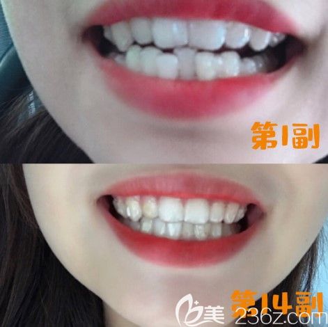 牙齿不齐矫正效果图