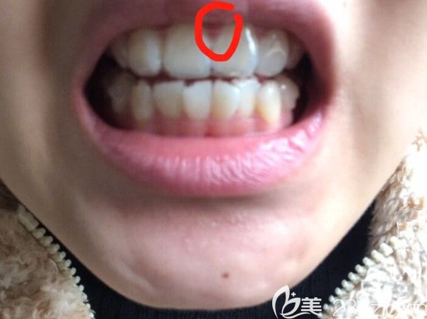 中间牙龈很闷