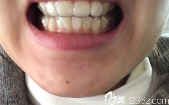 戴微笑隐形牙套2个月啦
