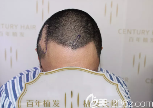 沈先生来院后医生检查了毛囊情况及疤痕部位的血运情况