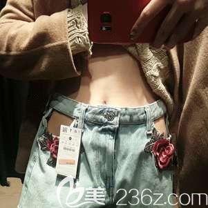 腰腹吸脂术后21天肿胀渐消 腰腹吸脂术后21天肿胀渐消