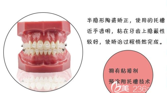这个托槽好处还挺多的嘛