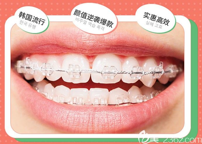 陶瓷半隐形托槽图示