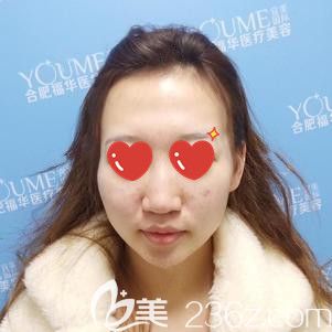 凹陷的面部和太阳穴 凹陷的面部和太阳穴