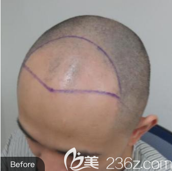 医生给我画出的种植区 医生给我画出的种植区