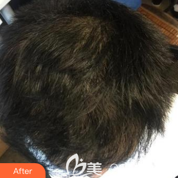 术后7个月头发变的又长又浓密 术后7个月头发变的又长又浓密