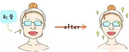 为什么有些人做完面部削骨手术之后会变老呢？