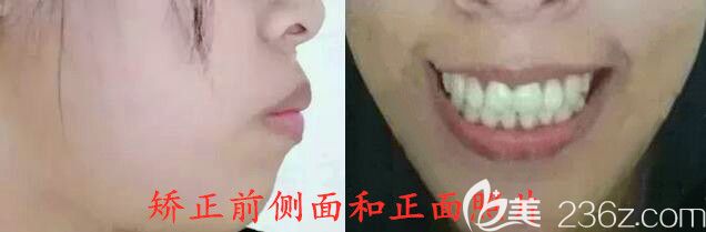 骨性龅牙矫正前照片