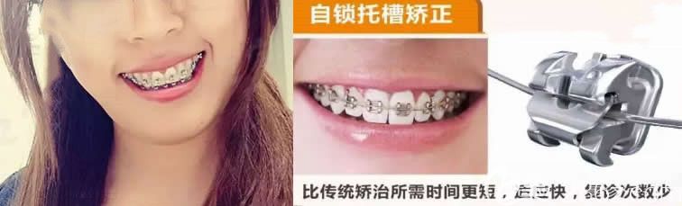 骨性龅牙在成都极光口腔戴自锁金属牙套