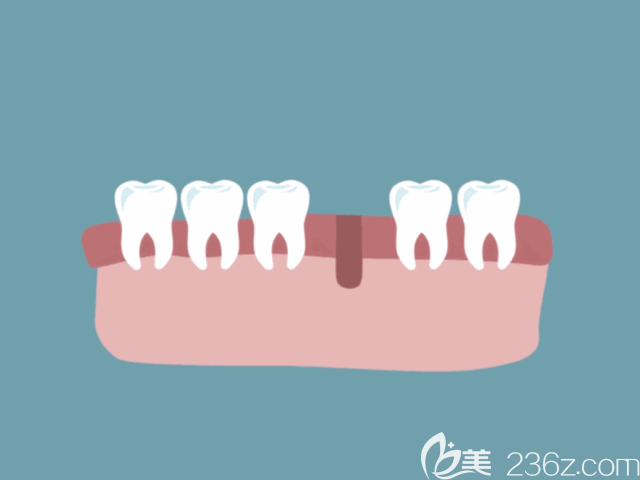 种植牙流程动态示意图