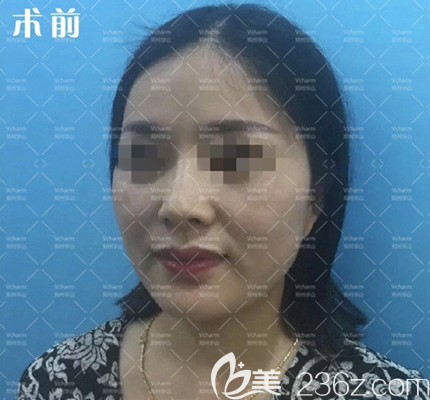 做面部埋线提升手术前 做面部埋线提升手术前