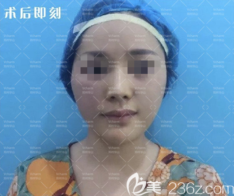 做完面部埋线提升手术后即刻 做完面部埋线提升手术后即刻