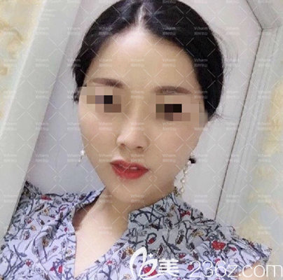 做完面部埋线提升手术15天 做完面部埋线提升手术15天