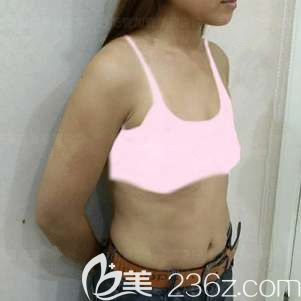 手术前自己平坦的胸 手术前自己平坦的胸