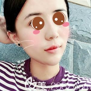 玻尿酸垫下巴术后即刻轻微肿胀