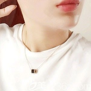 垫下巴术后12天基本恢复自然