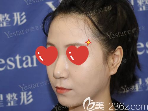 手术前鼻子上的小驼峰 手术前鼻子上的小驼峰